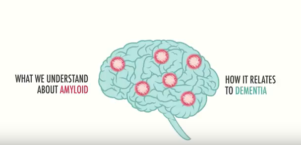 EPAD project launches an amyloid video